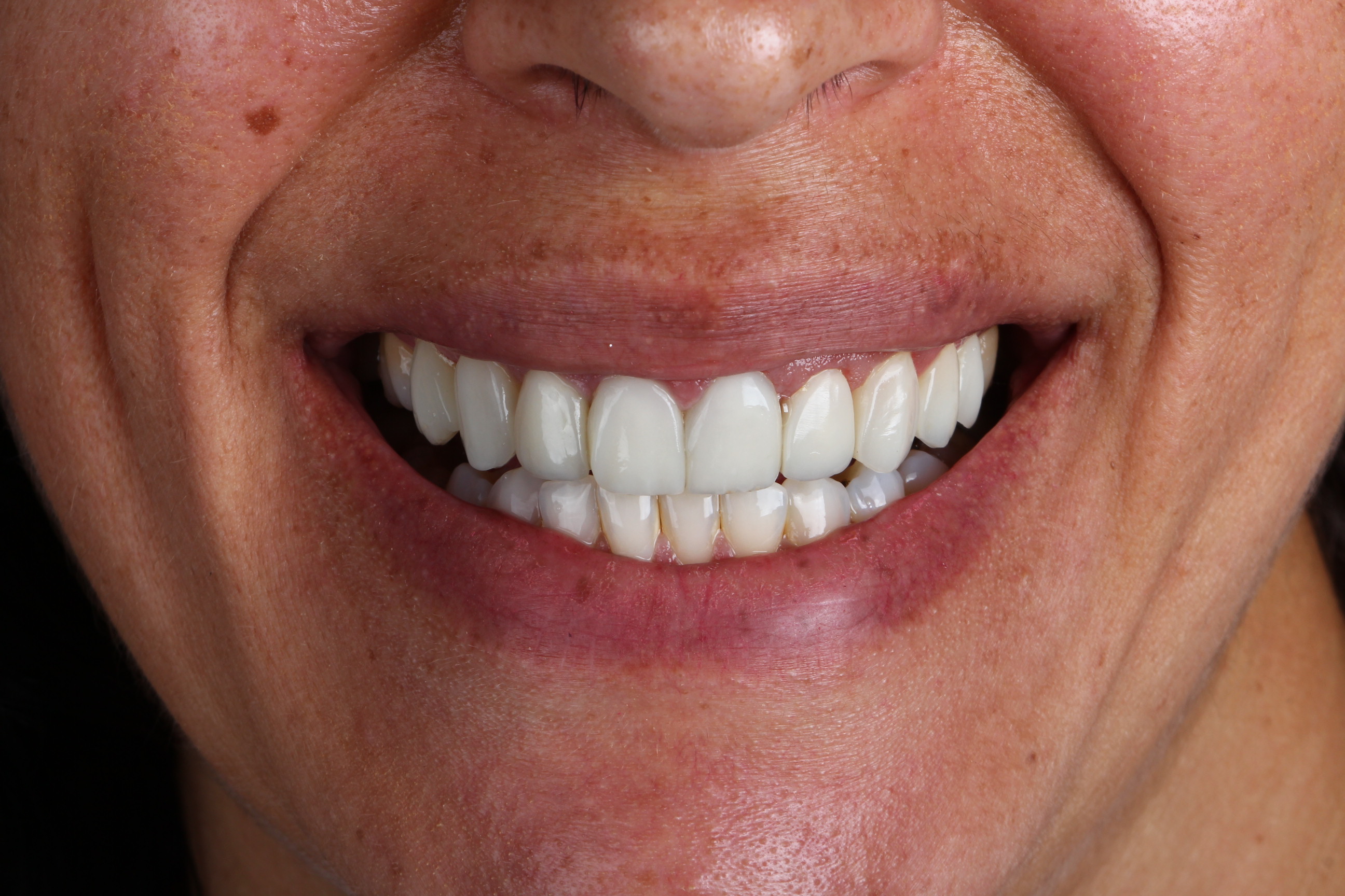 Depois de facetas dentárias